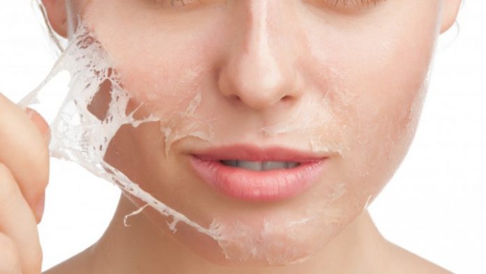 Chemical peeling treatment removes all your skin imperfections