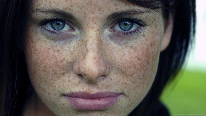 Freckle causes, symptoms, and treatment