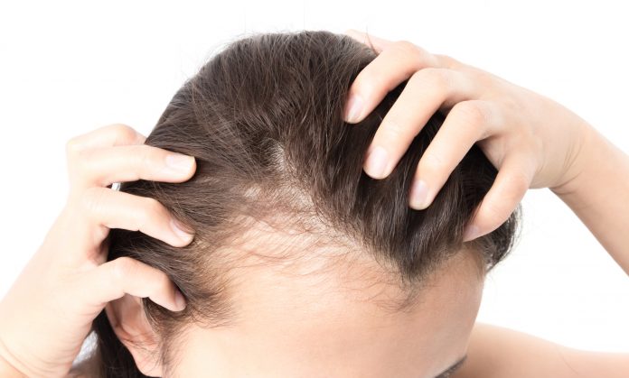 Hair loss treatment in Delhi