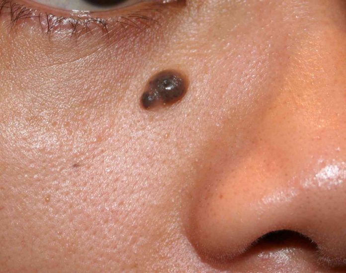 Remove moles permanently with these surgical Method