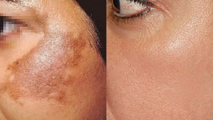 Chemical Peel and Laser Treatment for Pigmentation Removal