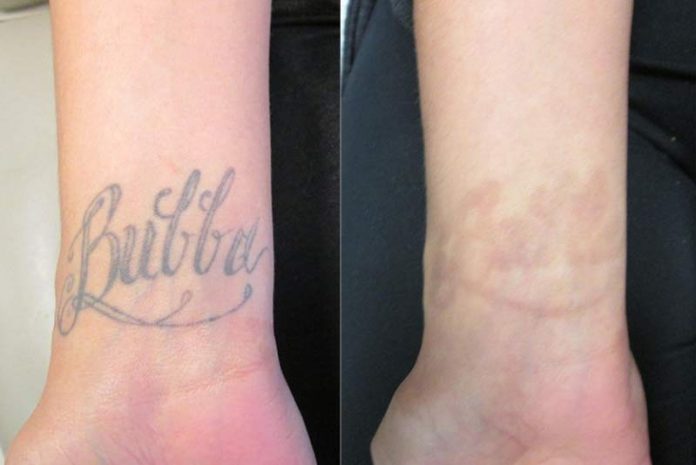 Tattoo removal treatment in Delhi