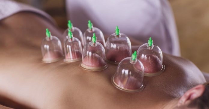 Cupping therapy is the best treatment for every health issue