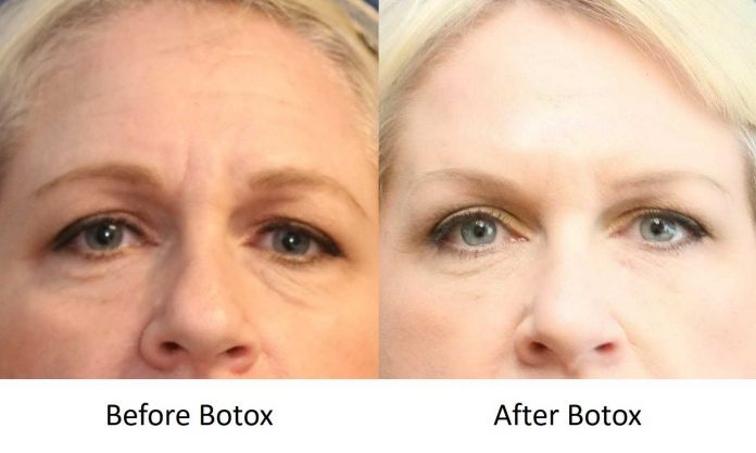 Botox treatment in Delhi will reverse your age