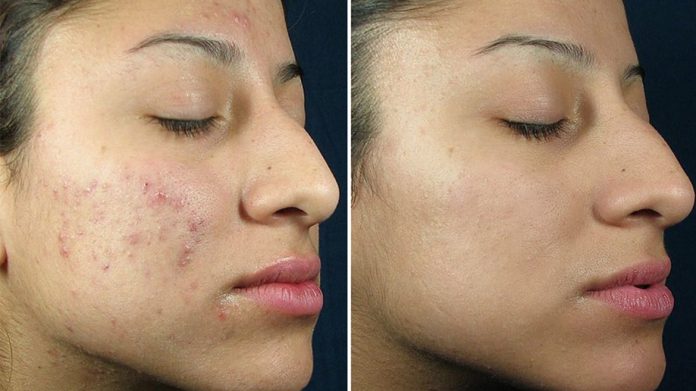 Chemical peel treatment Is safe or not