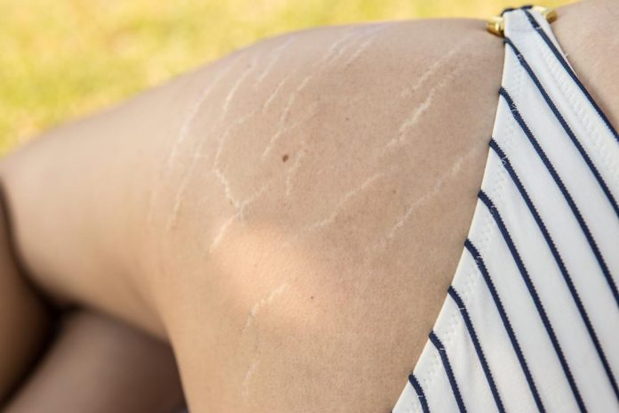 Laser stretch marks removal, procedure, results and recovery