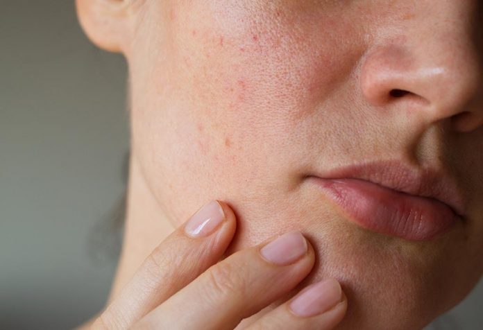 Open pores treatment, causes, procedure and guidelines