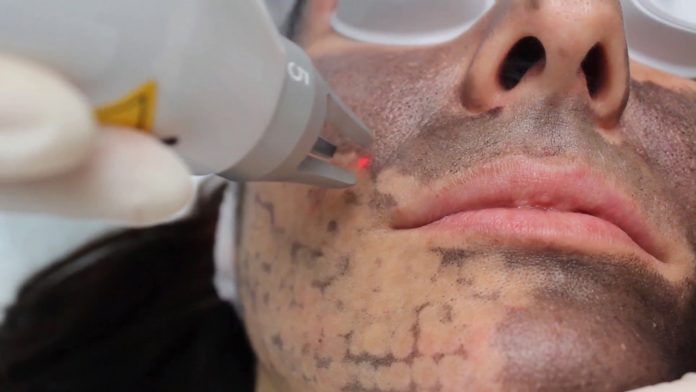 Q switched Laser Will Remove all Your Skin Imperfections