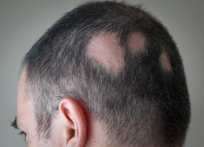 Best hair growth formula in Delhi for hair loss treatment