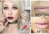 Lip filler process, results, recovery and cost